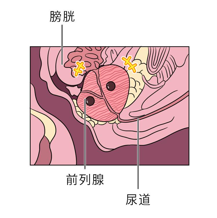 尿痛等症状前列腺增生不同颜色尿液问题可在后台回复"尿液"查看详