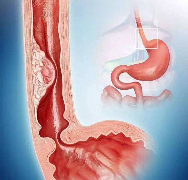 人体的胃肠道是象房子的墙壁样是分层结构,靠近管腔面的最里层是粘膜