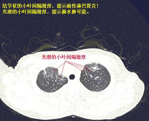 图05小叶间隔增厚,并且是光滑的小叶间隔增厚,提示肺水肿.