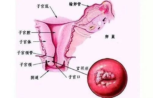 子宫癌的早期症状图片