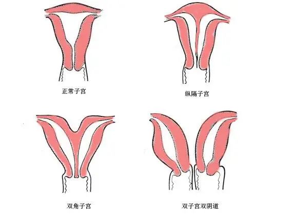 女性双子宫能怀孕吗