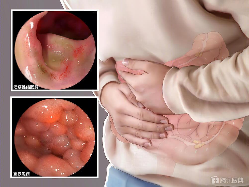 27岁小伙肠穿孔无人敢收治术后2年流黄水只因这个习惯