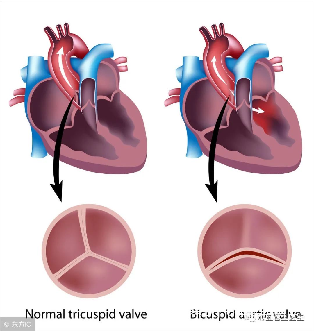 瓣膜问题并不是所有的心脏病都需要终生服药,有一部分心脏病不需要