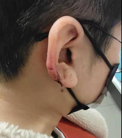 焦点丨银川女子去理发结果耳朵被剪掉一块