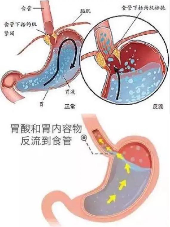 科普丨手術前是否需要長時間禁食禁水麻醉醫生告訴你