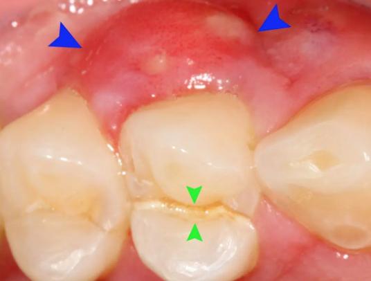 牙周脓肿怎么治图片