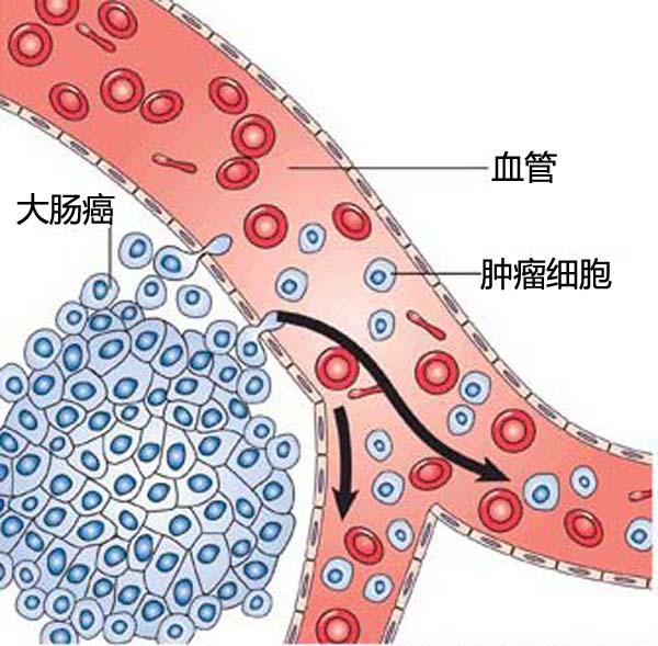 结直肠癌术后需要检查项目有哪些