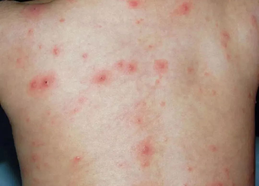 婴孩遭受严厉荨麻疹，风疹的皮肤纹理 库存照片. 图片 包括有 木瓦, 过敏, 爱好健美者, 红色, 临时 - 87065016
