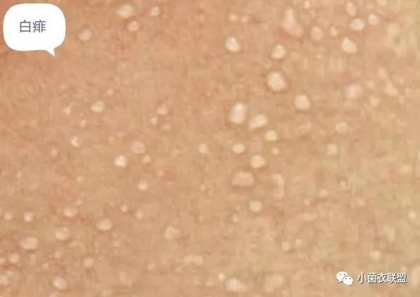 奶癣不是癣妈妈莫大意