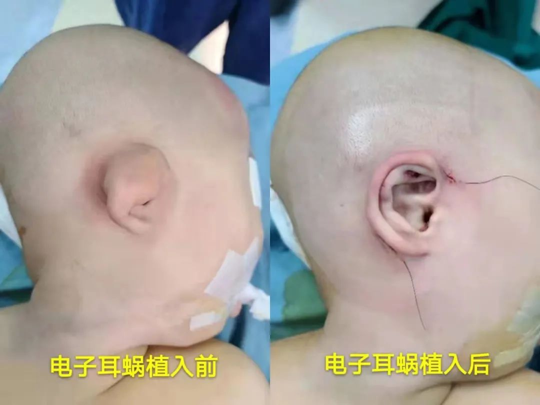 患儿欢欢(化名)手术前后1个月后,欢欢的电子耳蜗就可以开机,届时将