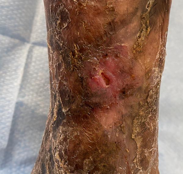 老伯1年多不愈合的伤口,好了