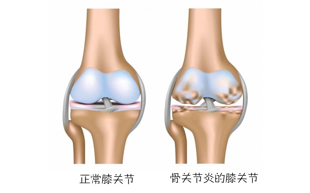 【健康百科】当我的老寒腿和寒潮之间只隔着一条秋裤