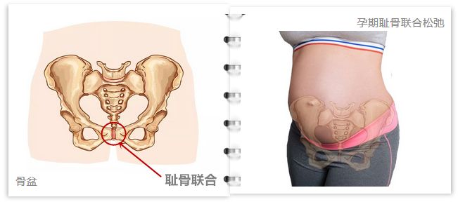 有一种分离的痛,叫耻骨联合分离