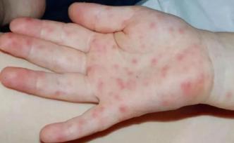 手足口、幼儿急疹、水痘、风疹、川崎病……看图识别不同皮疹