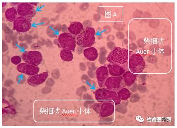 一例獨特的急性早幼粒細胞白血病