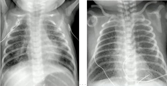 宝宝正常的肺部ct图片图片
