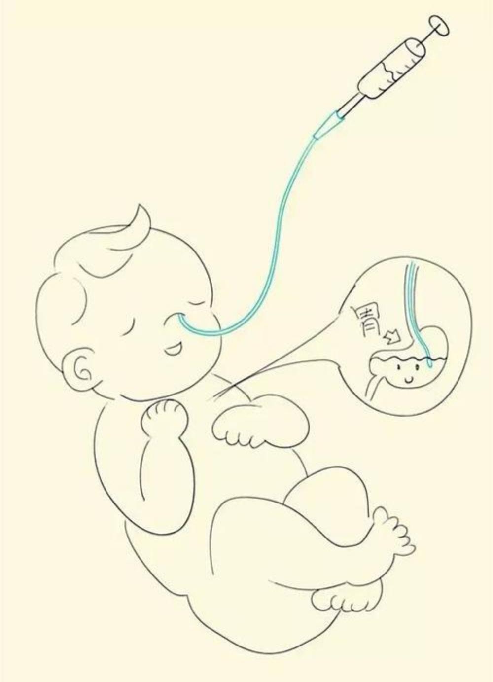 小新是个刚满月的宝宝,在特诊部住院期间,医生根据宝宝病情留置了胃管