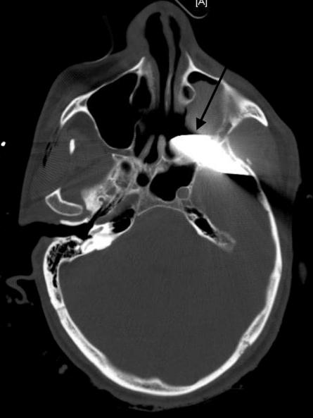 显示刀穿透左侧颞骨,左侧蝶骨,左侧翼腭窝和左侧上颌窦(图1,2,3)