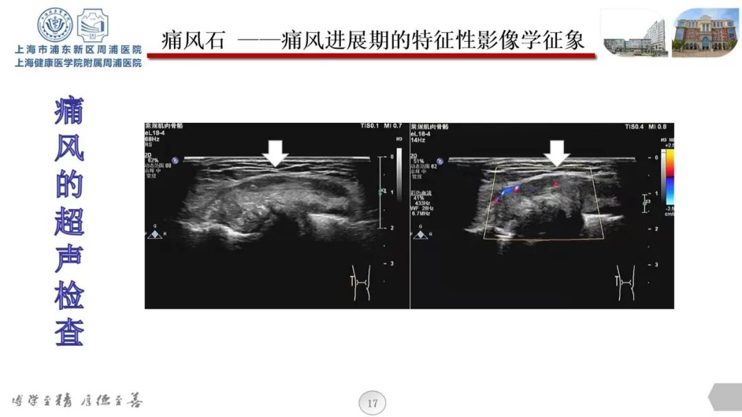 痛风肾超声图片图片