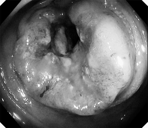 直肠菜花状肿瘤图片图片