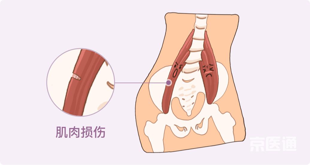 腰闪了怎么办8个护腰小窍门教给你