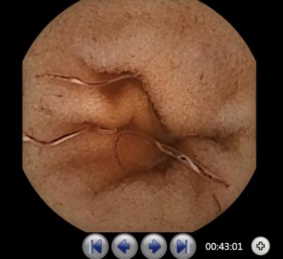 胶囊内镜下看见的小肠寄生虫肠道钩虫病是钩虫寄生人体小肠后所导致的