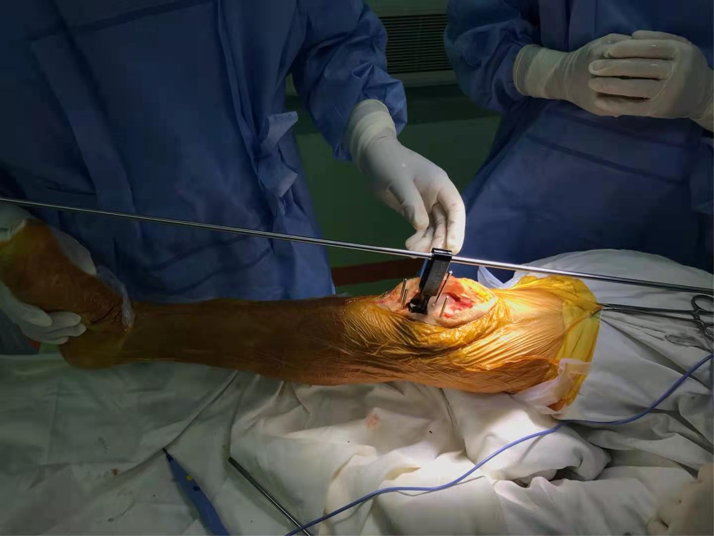 一例严重膝外翻合并骨关节炎患者行膝关节表面置换术