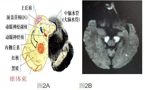 1例閉鎖綜合徵病變卻不在腦橋