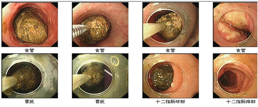 明白了,原来胃里高密度的东西是结石啊.