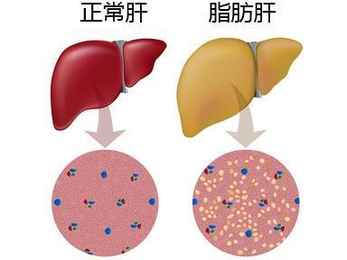 科普脂肪肝治療千萬別盲目節食