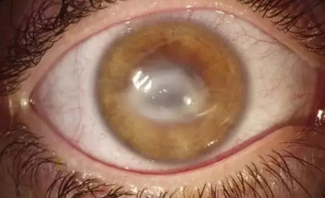隐形眼镜佩戴不当女孩两次角膜移植后险丧命
