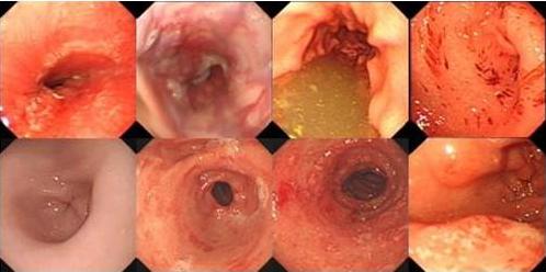 上消化道出血:食管黏膜糜烂及溃疡可以导致呕血和(或)黑便,伴有不同
