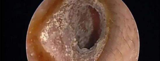 耳屎到底要不要掏原来这么多年都错了