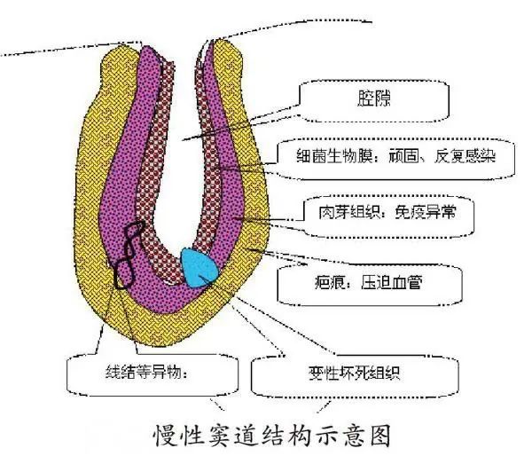 t管窦道形成图片图片