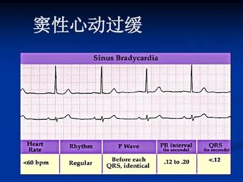 曙光科普窦性心律是什么过缓过速不齐要紧吗