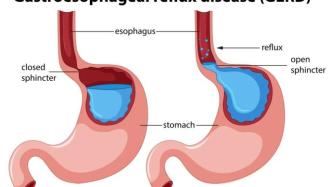 JAMA子刊：5个日常小习惯，显著减轻胃食管反流病症状