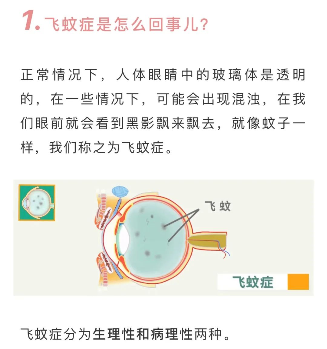 眼前有小飛蟲在飛就是飛蚊症嗎什麼情況下就需要治療了