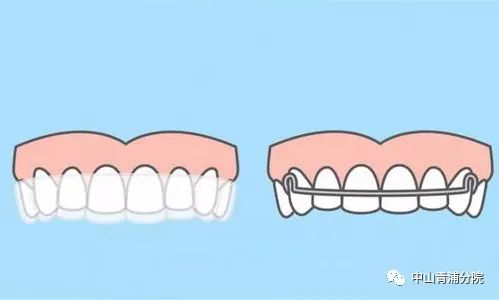 隐形矫正还你天使笑容