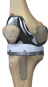 铰链旋转式人工膝关节图片