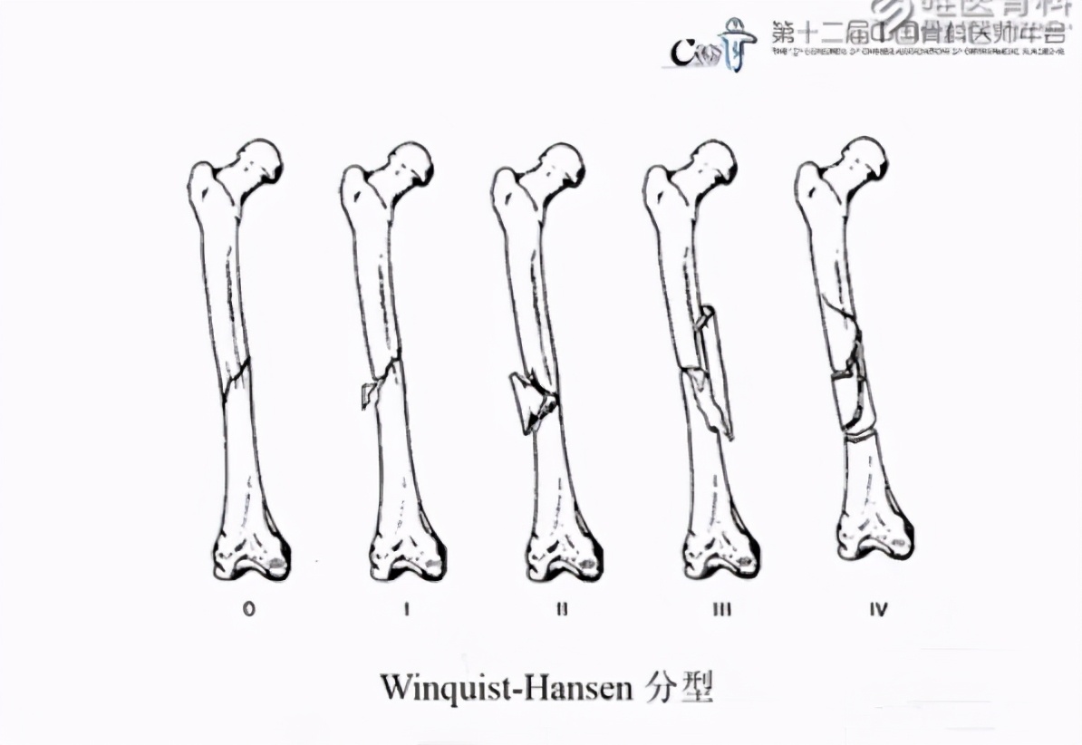 股骨干骨折含蝶形骨块有专门的分型,比如ao分型,winquist-hansen分型