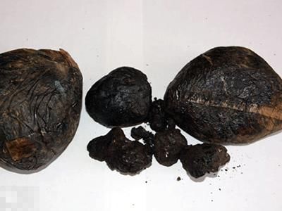 鸦片成瘾及戒断症状:滥用者会出现瞳孔缩小,畏光,肌体消瘦,说话含混不