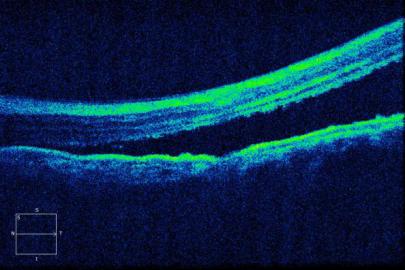 左眼oct提示黄斑区视网膜脱离术前53岁的蔡先生因左眼外伤导致视力