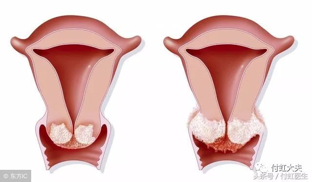 24岁查出hpv高危型感染是否需排除宫颈癌