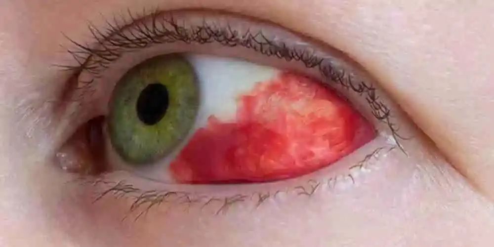白血病眼睛是什么颜色图片