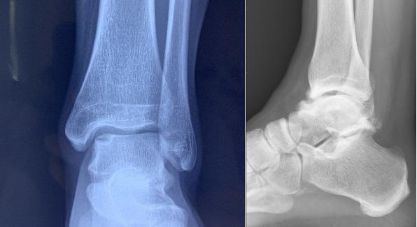 反复崴脚可不是什么小事