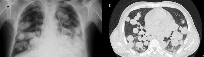 bmj子刊炮弹样肺转移瘤长啥样
