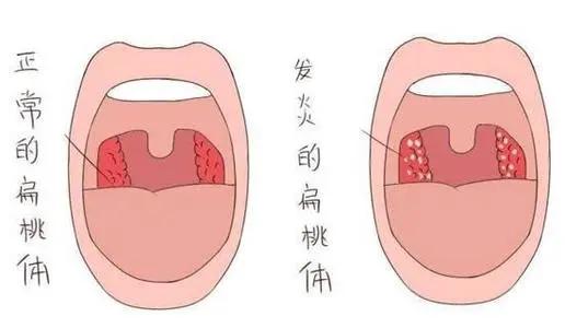 扁桃体脓栓图片图片