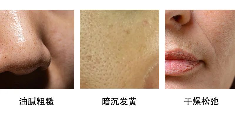 加速皮肤衰老,使皮肤暗沉,无光泽,松弛粗糙等