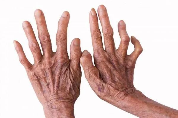 世界防麻风病日让人闻风丧胆的麻风病到底是什么样的病