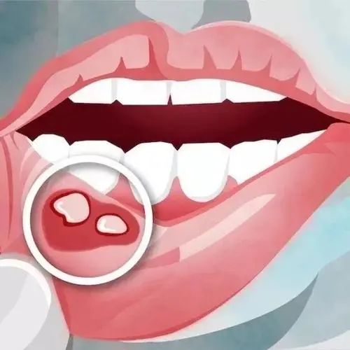 口腔溃疡惹人恼预防才是关键